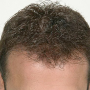 Hair Loss Restoration - After