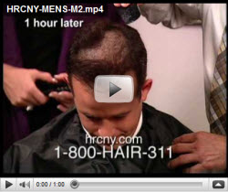 Men's Hair Replacement New York